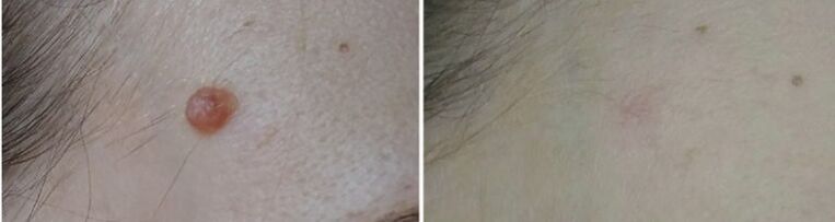 before and after laser papilloma removal photo 2