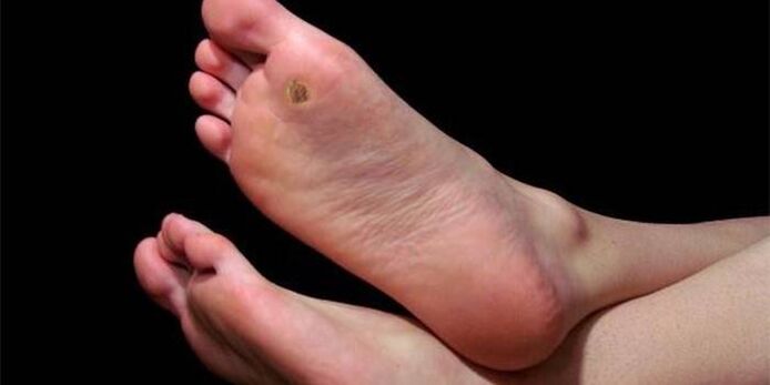 Plantar wart (spike) on the foot
