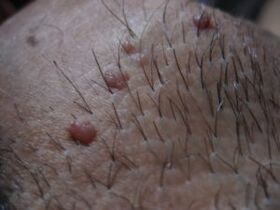 Lemmica Papilla