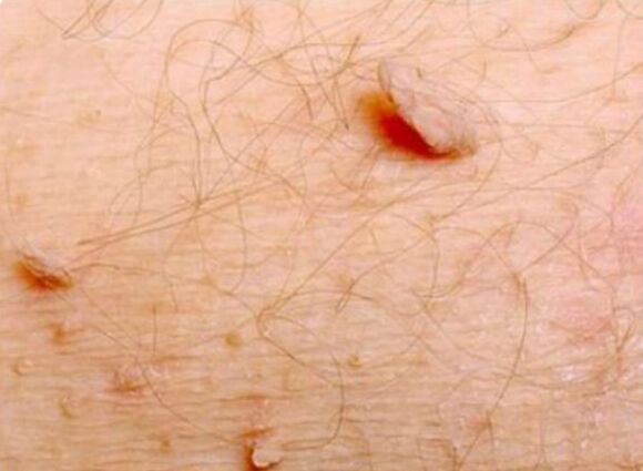 Sharp papillomes on the human body