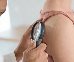 How to determine the virus of the human papillom