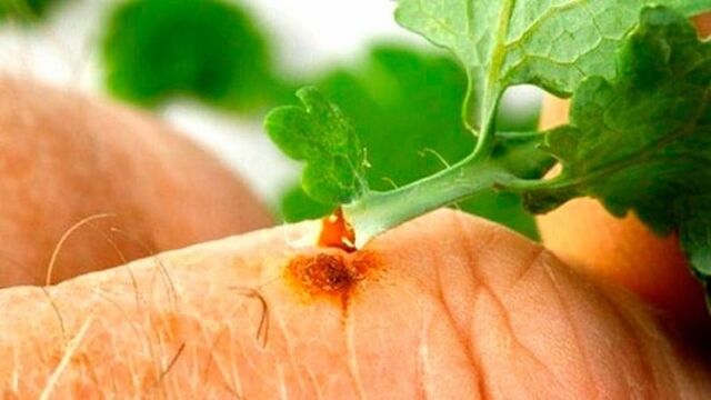 Applying celandine juice to the wart