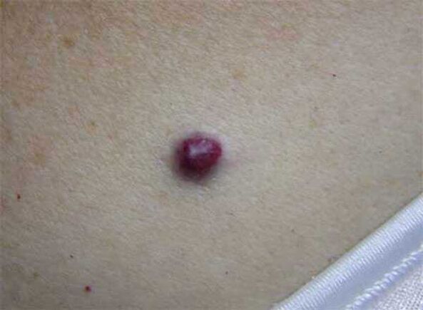a red mole on the body