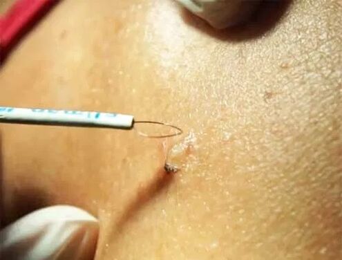 papilloma removal