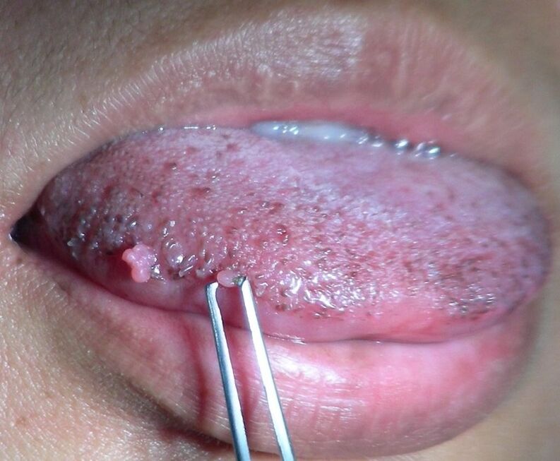 condylomas on the tongue