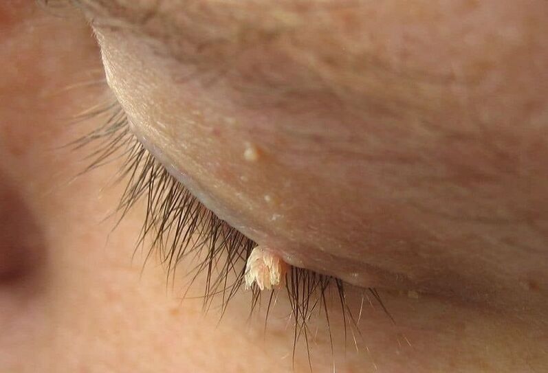 filamentous wart on the eyelid