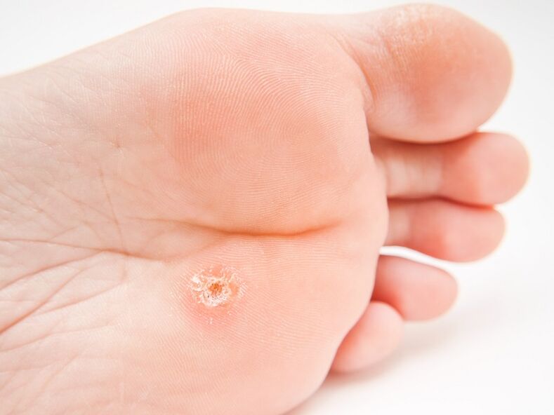 plantar warts on the foot