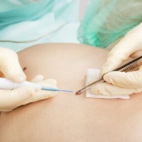 removal of papillomas by a surgeon