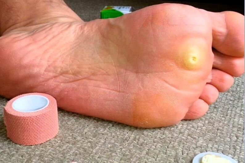 plantar warts on the foot