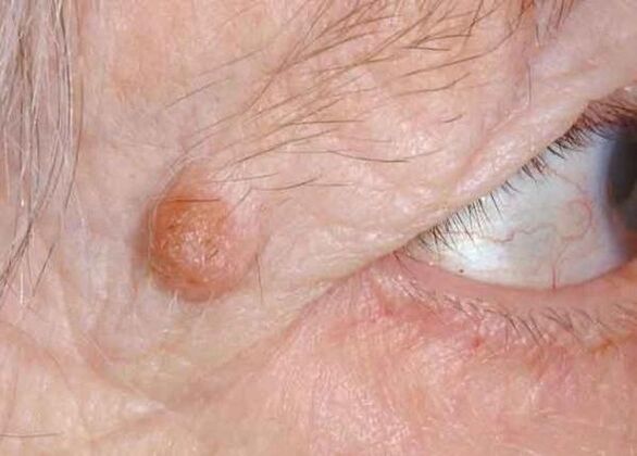 Papilloma on the eyelid