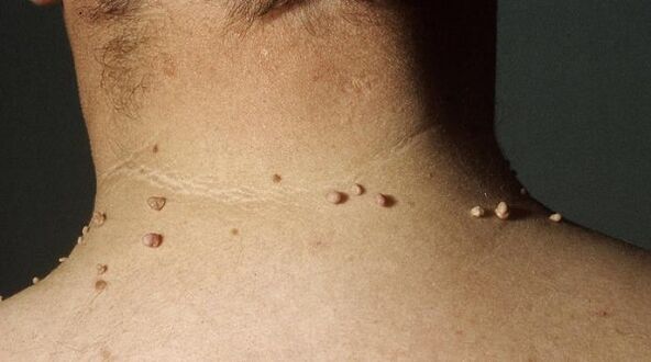 filiform papilloma on the neck