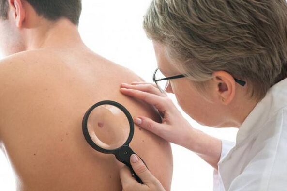 the doctor examines the papillomas on the back