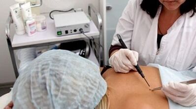 Electrical agulations as a method of removing the warts