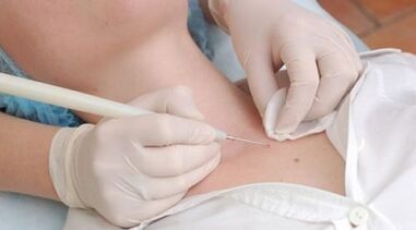 Laser nipple removal